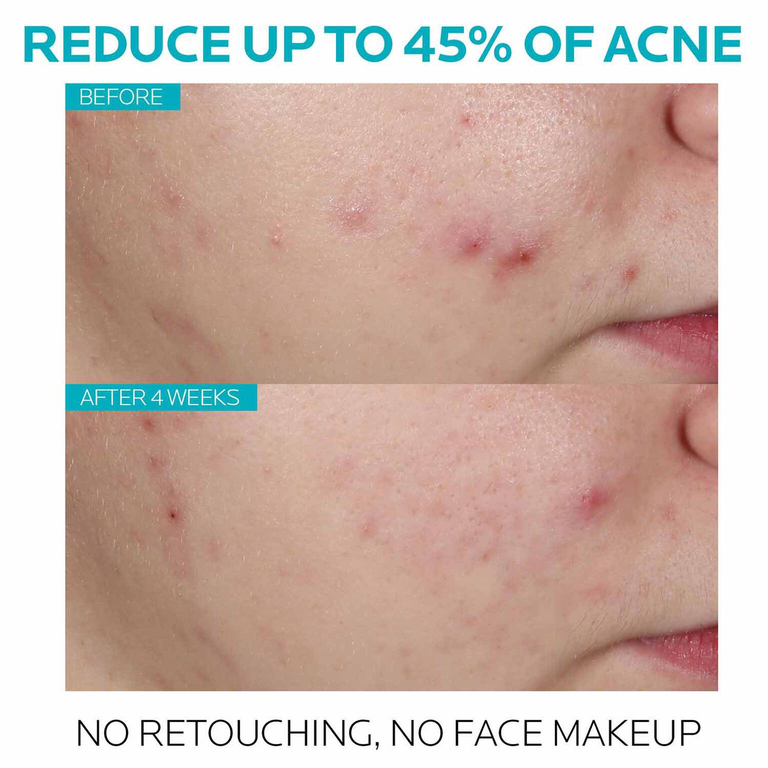 effaclar-salicylic-acid-acne-treatment-serum-d0 7_EffaclarSerum_After-45-days.jpg