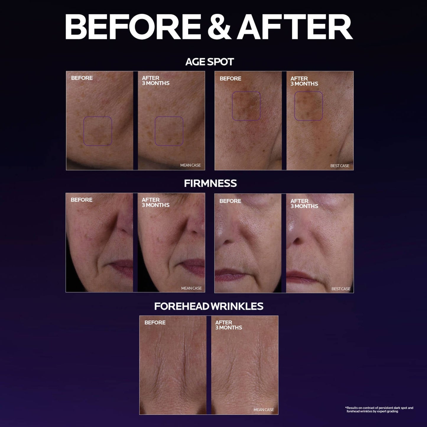 mela-b3-double-dose-discoloration-treatment-with-melasyltm-f7 MelaB3_DD_BTF_BeforeAfter_1500x1500_5.jpg