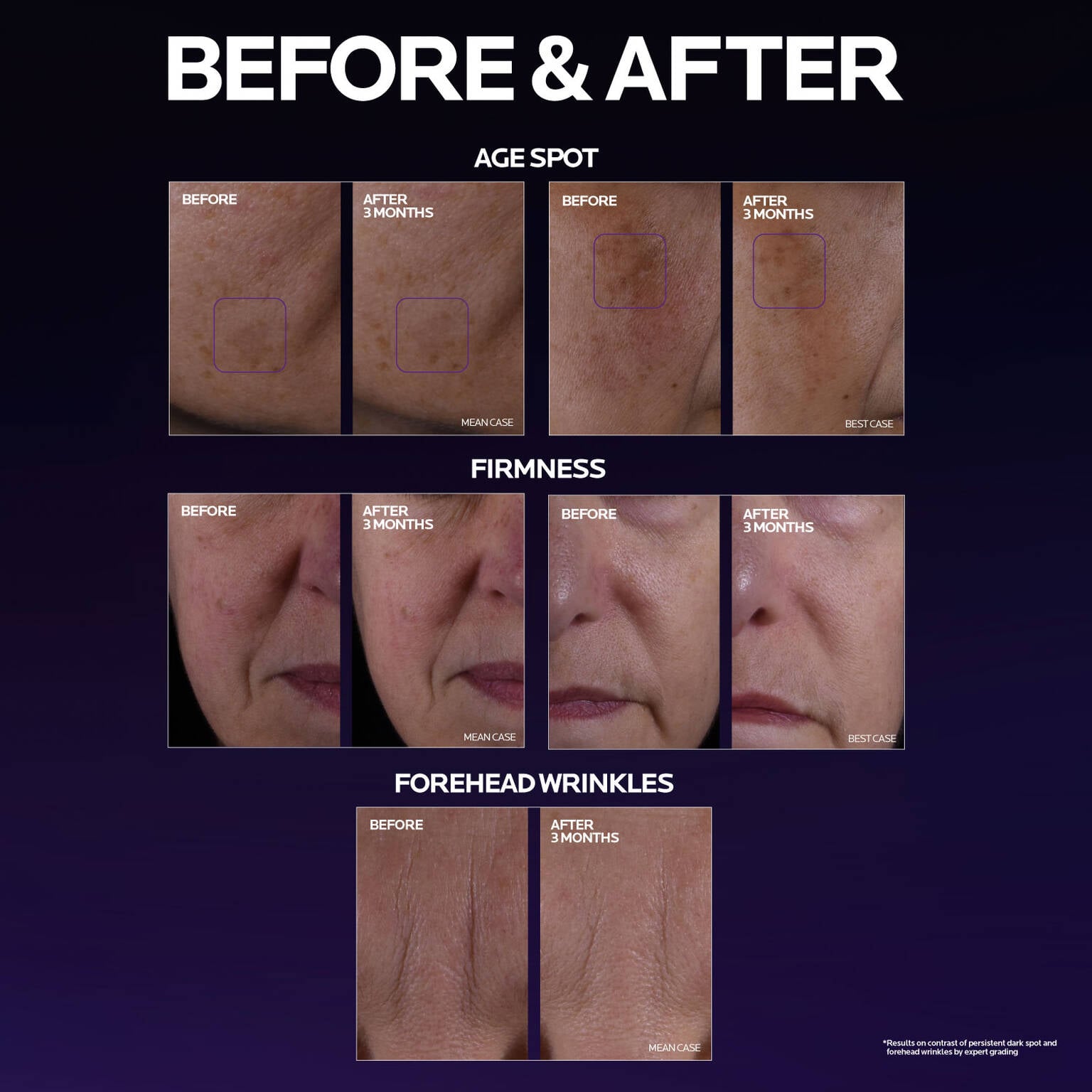 mela-b3-double-dose-discoloration-treatment-with-melasyltm-f7 MelaB3_DD_BTF_BeforeAfter_1500x1500_5.jpg